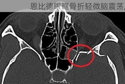 恩比德眼眶骨折轻微脑震荡,