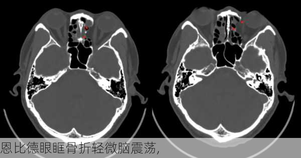 恩比德眼眶骨折轻微脑震荡,